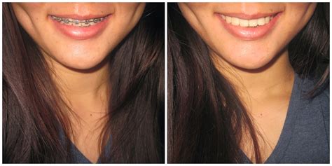 braces auburndale|Braces Auburndale Reviews, Ratings .